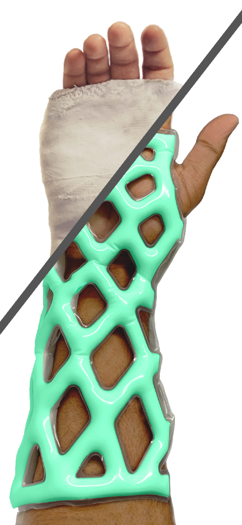 New mesh-type cast aims to replace plaster cast < Device/ICT < Article - KBR